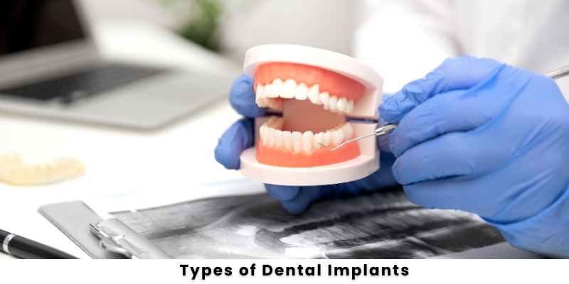 Dental Implants