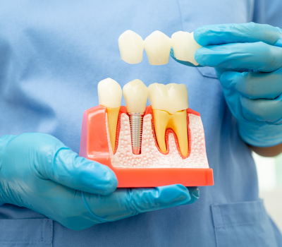 Permanent and Natural-Looking Tooth Replacement