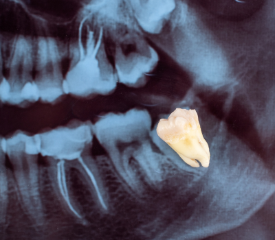Minimally Invasive Techniques