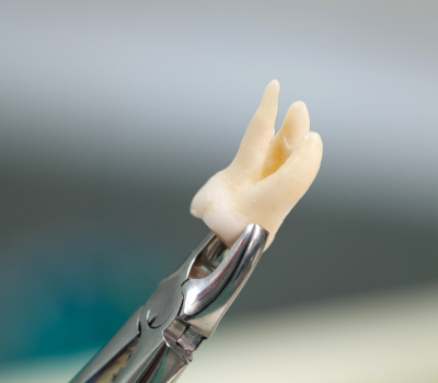 Understanding Wisdom Tooth Extraction